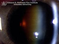 Brunescent cataract demonstrating dark brown lens nucleus